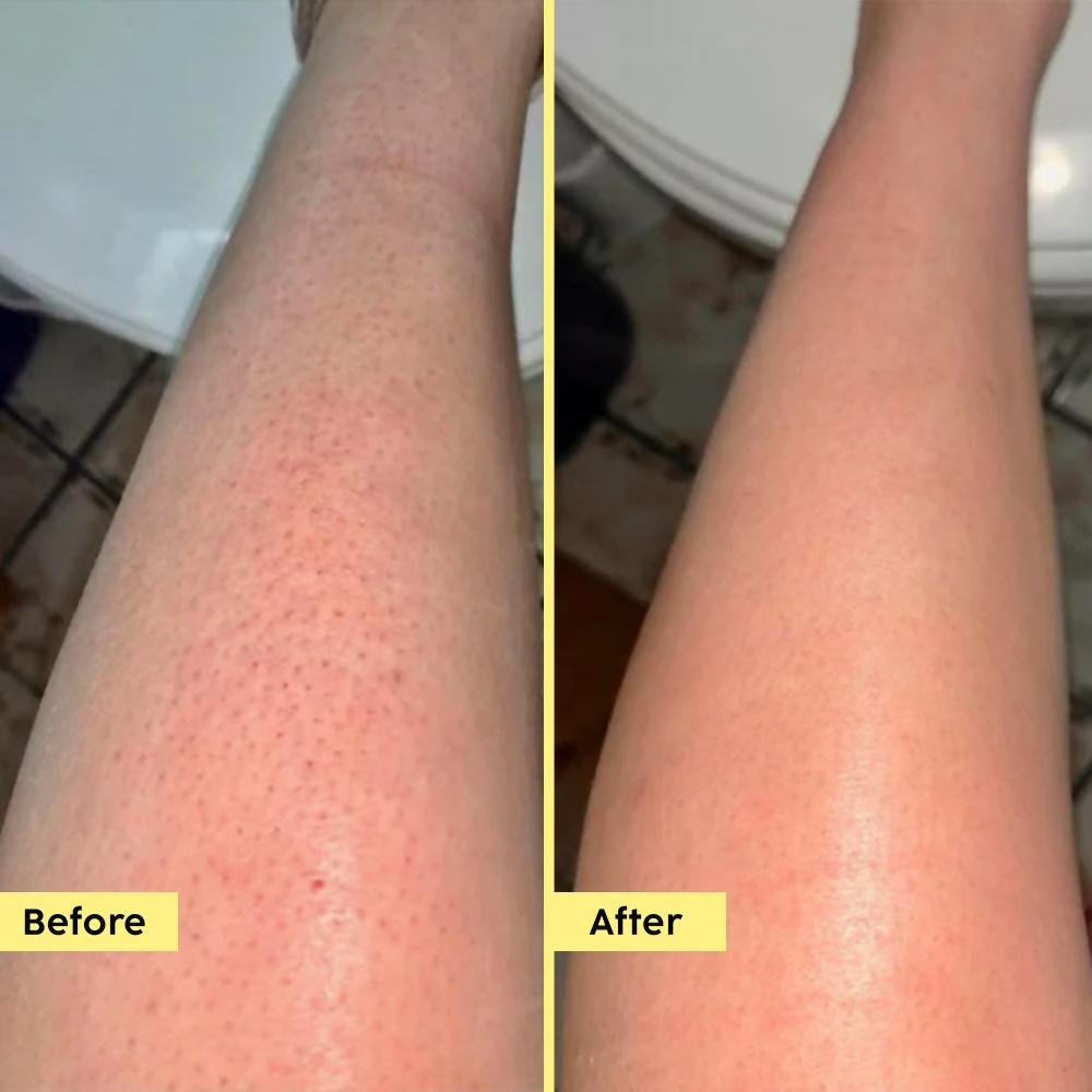 PLIX The Plant Fix Pineapple 5% Lactic Acid Body Wash Exfoliates Dry, Rough & Strawberry Skin